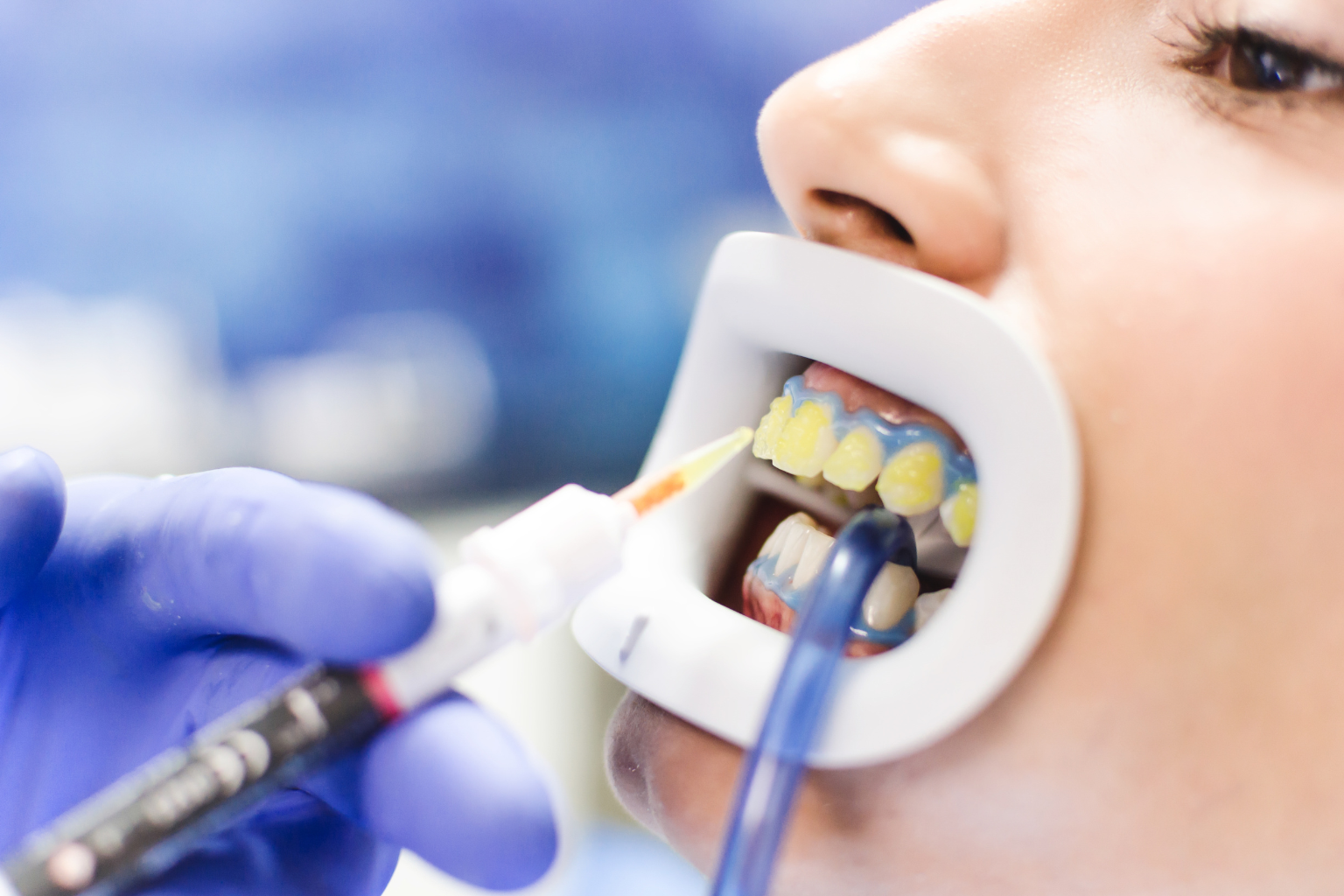 ภาพประกอบวีเนียร์