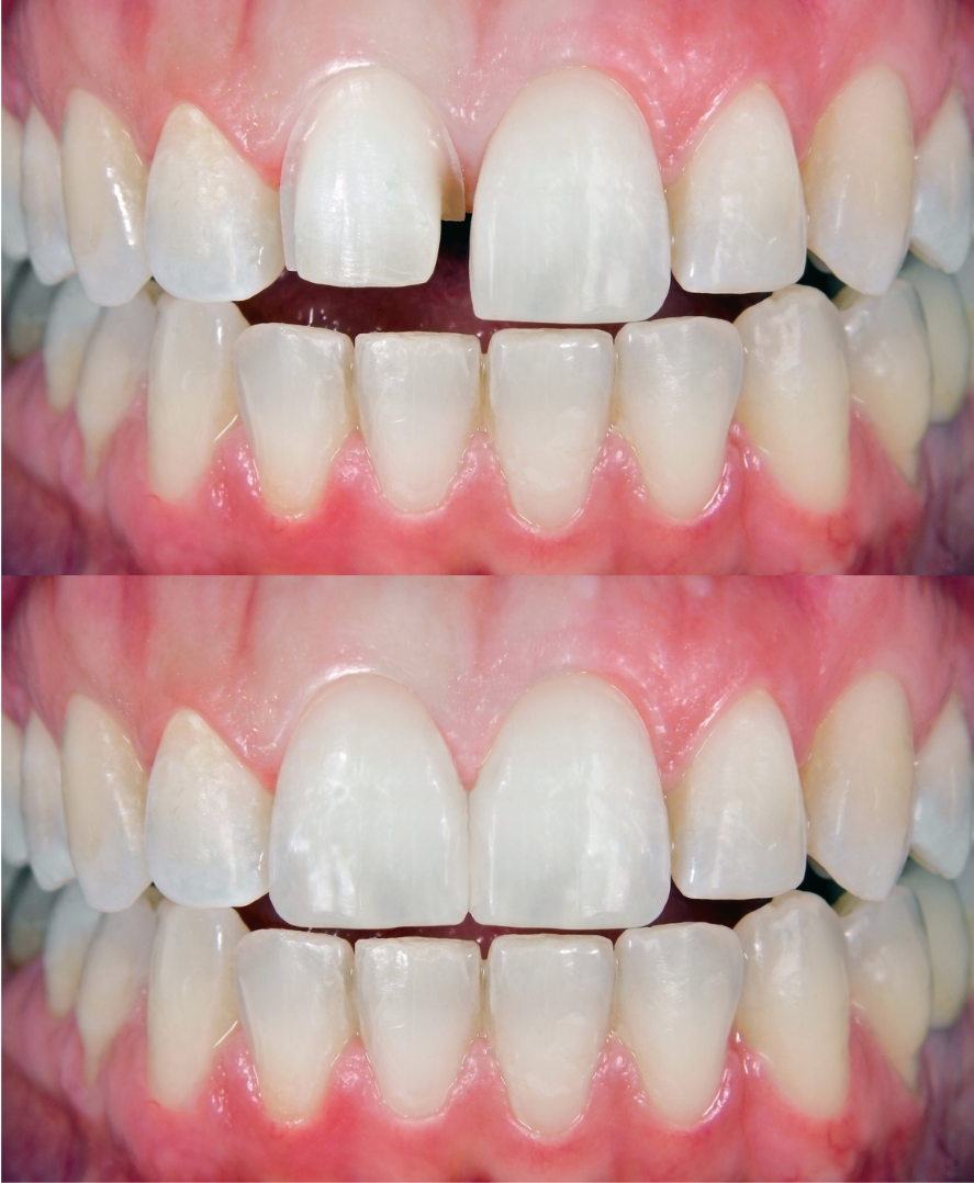 ภาพประกอบประเภทของวีเนียร์